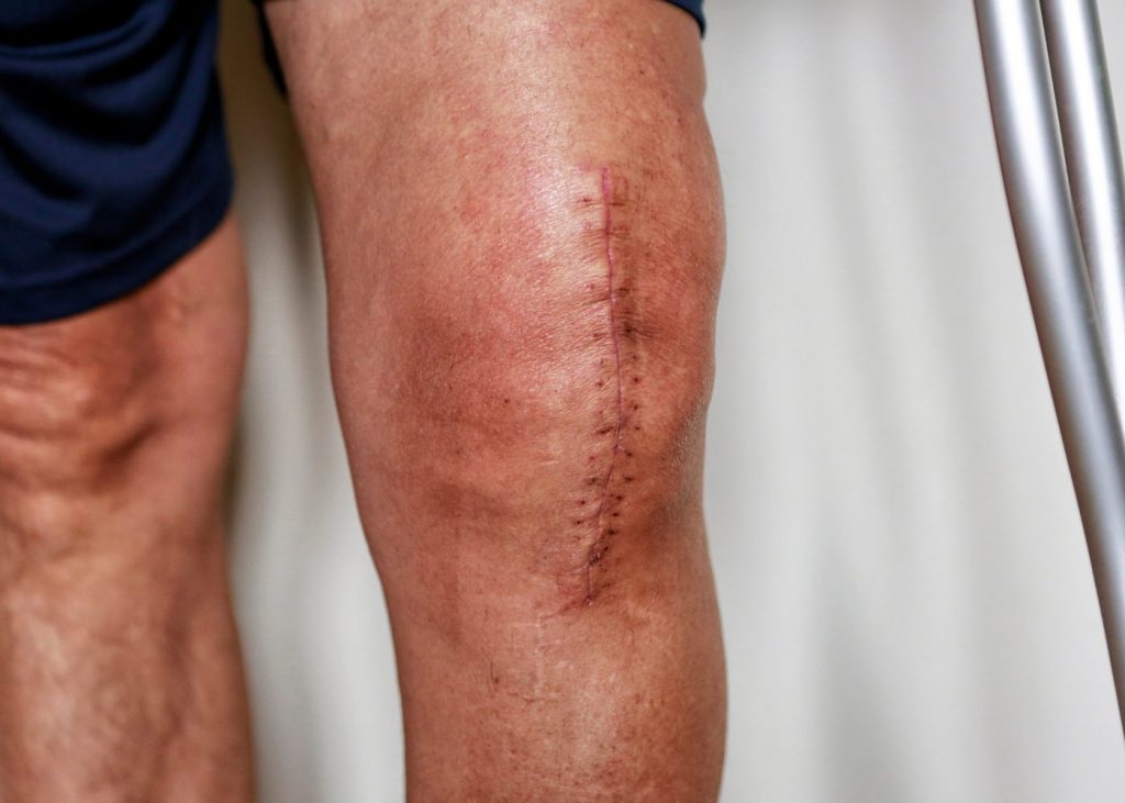 Knie nach Operation mit Operationsnarbe – typische Ausgangssituation für die physiotherapeutische Nachbehandlung